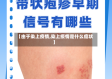 【由于染上疫情,染上疫情是什么症状】