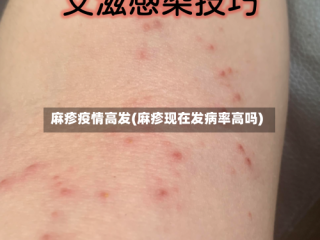 麻疹疫情高发(麻疹现在发病率高吗)