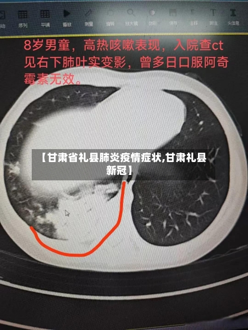 【甘肃省礼县肺炎疫情症状,甘肃礼县新冠】-第1张图片