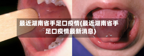 最近湖南省手足口疫情(最近湖南省手足口疫情最新消息)-第2张图片