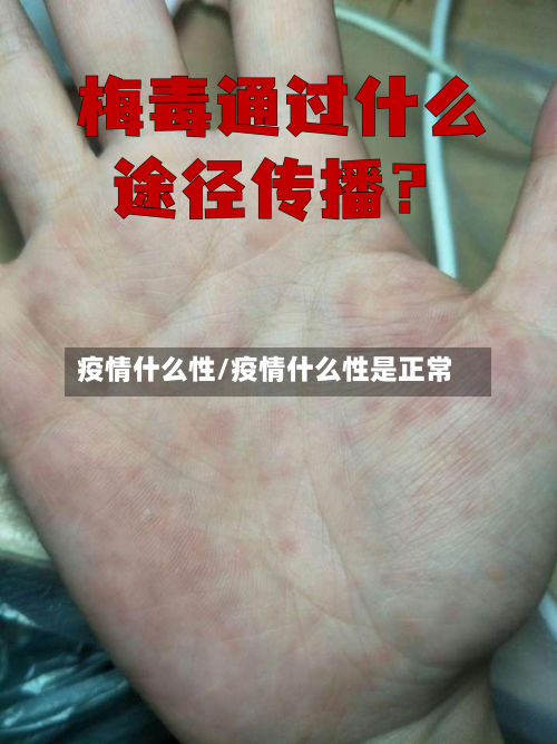 疫情什么性/疫情什么性是正常-第3张图片